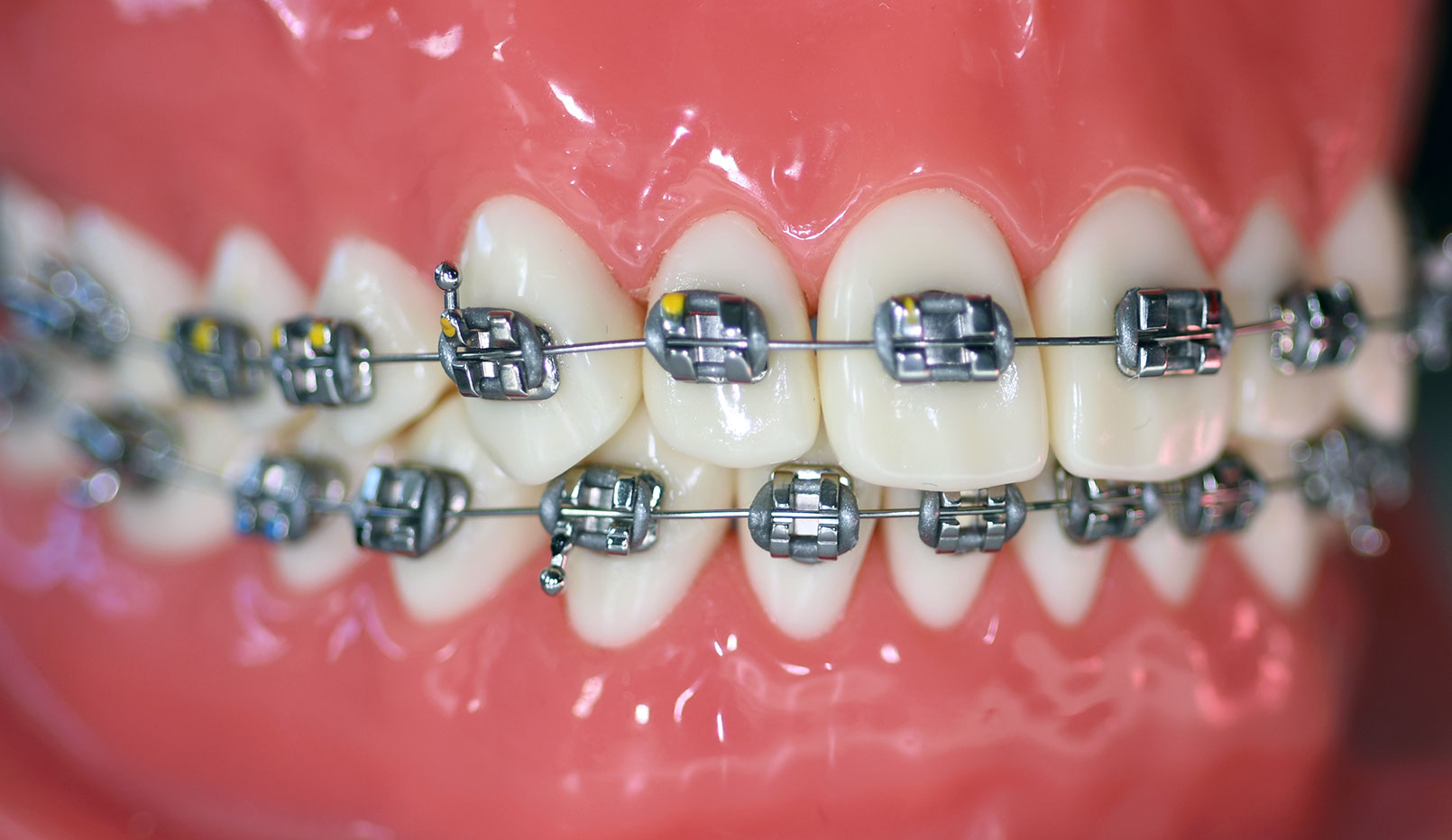 Tandställning på modell. En behandlingsmetod för tandreglering.