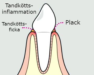 Bild på tandköttsinflammation, gingivit.