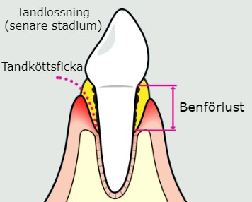 Bild på senare stadie av tandlossning, parodontit