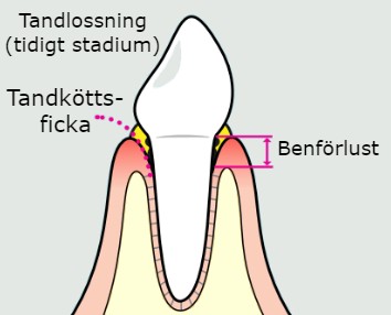Bild på tidigt stadie av tandlossning, parodontit